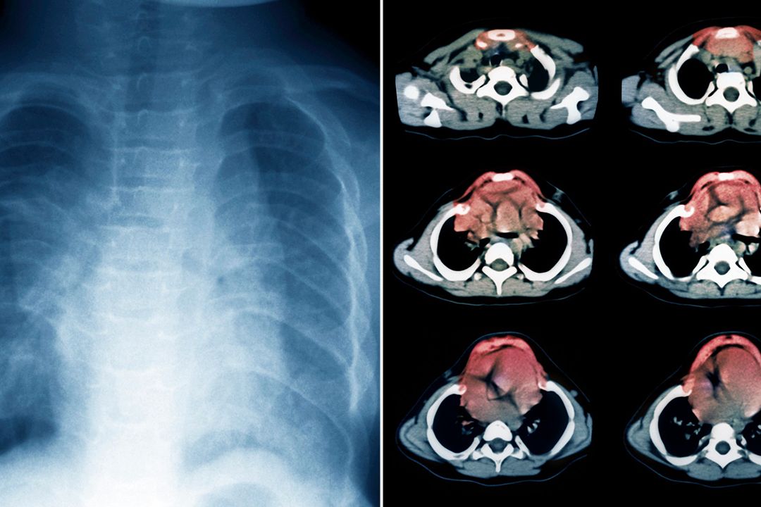 Jeuneův syndrom: vlevo rentgenový snímek hrudníku dvouletého dítěte, vpravo jeho barevná počítačová tomografie. Nemoc ovlivňuje vývoj kostí a chrupavek, žebra jsou pak menší a hrudník užší, než je obvyklé. To neumožňuje správný vývoj plic.