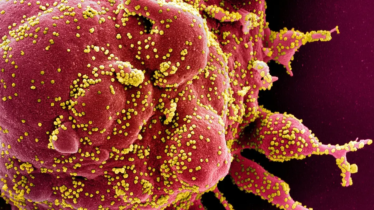 Umírající buňka napadená koronavirem (žluté body)