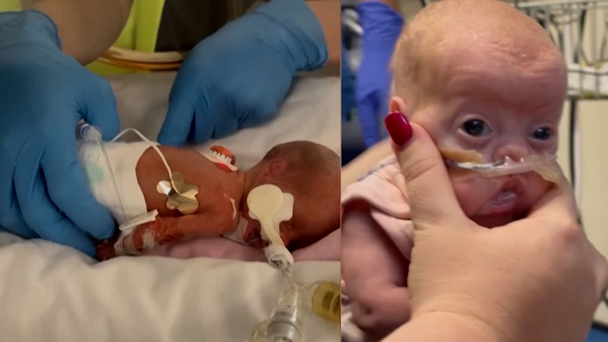 Dvojčata se narodila předčasně ve 23. týdnu těhotenství. Jedna ze sester zemřela, druhá svůj život vybojovala
