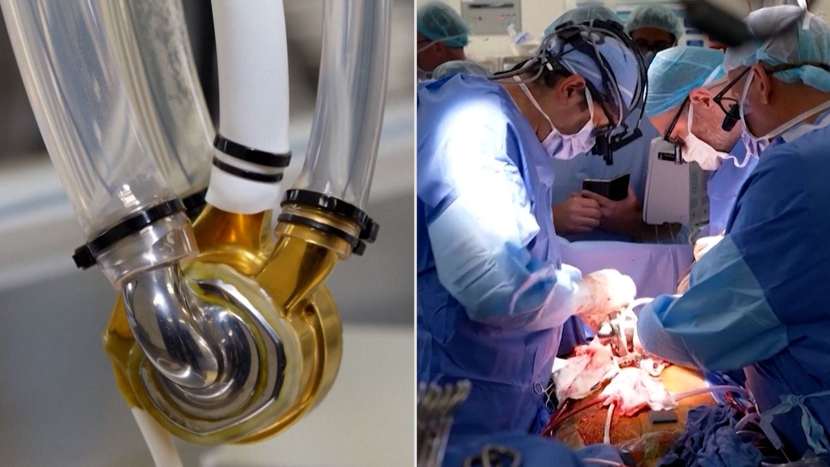 Australan díky umělému srdci z titanu přečkal 100 dní do transplantace. Nejdéle ze všech