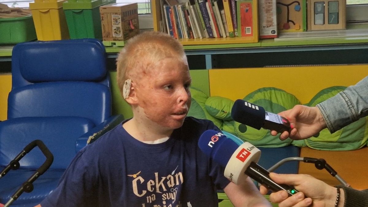 Těžce popálený chlapec byl v ohrožení života, po 22 operacích se těší na návrat k tanečním tréninkům