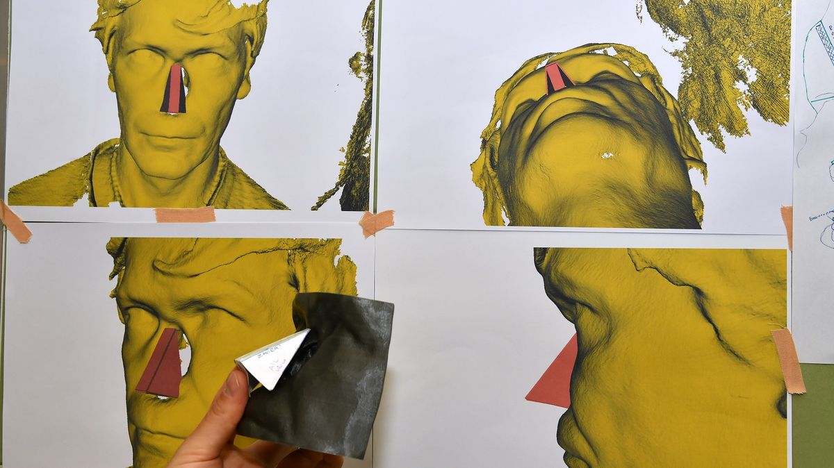 Muž kvůli rakovině přišel o celý nos a měl v hlavě díru. Plastičtí chirurgové v Brně mu udělali nový