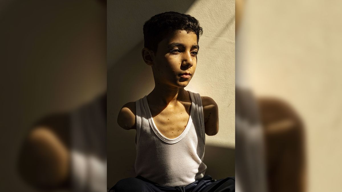 FOTO: Snímkem roku je portrét palestinského chlapce s amputovanýma rukama