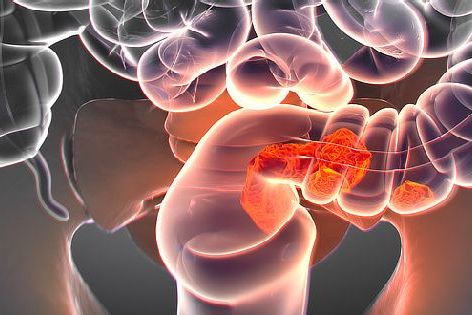 Jednoduchý test by mohl vystřídat kolonoskopii při preventivním vyšetření na rakovinu střev