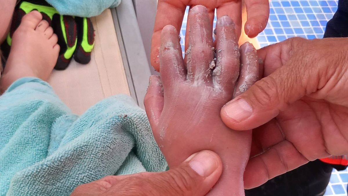 Odsávač hotelového bazénu na Mallorce vcucnul čtyřletému chlapci ruku po loket. Záchranu přinesly až sbíječky