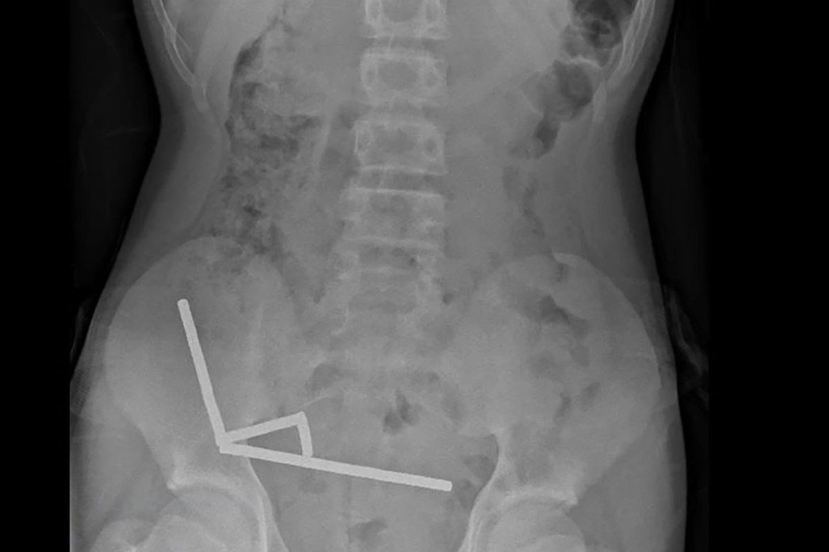 Teenager na Novém Zélandu spolykal stovku magnetů. Ty se mu ve střevech spojily