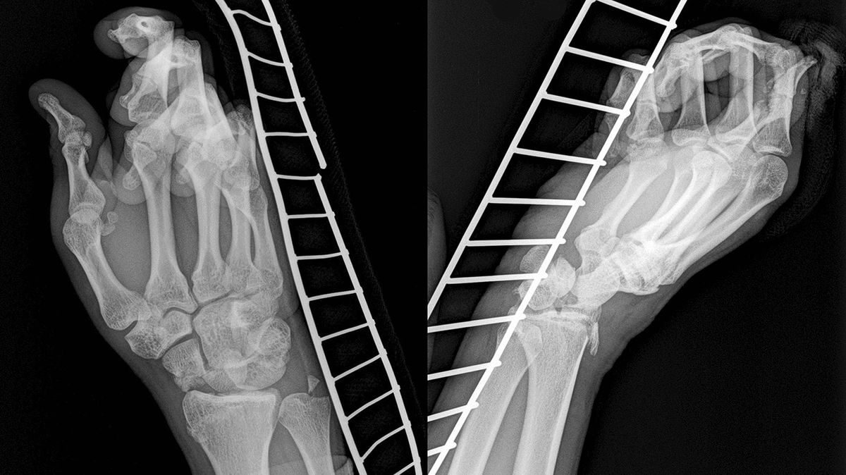 Muž utrpěl unikátní úraz, práce novoměstského ortopeda obletěla svět