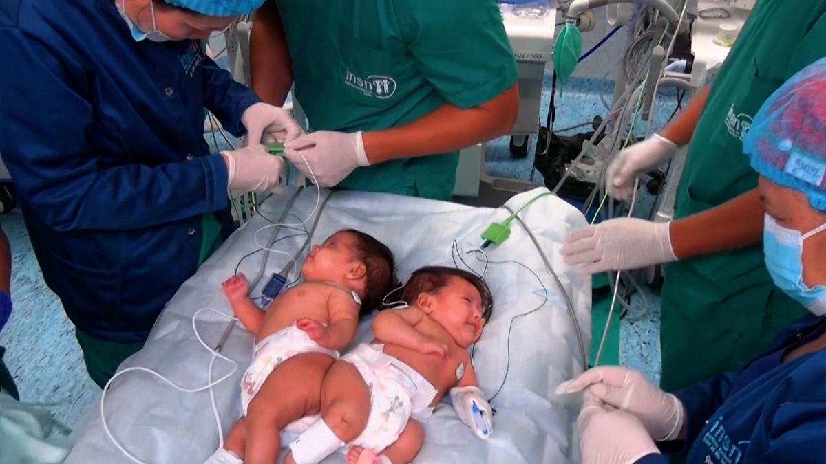 Vánoční zázrak: V Peru úspěšně oddělili dvouměsíční siamská dvojčata