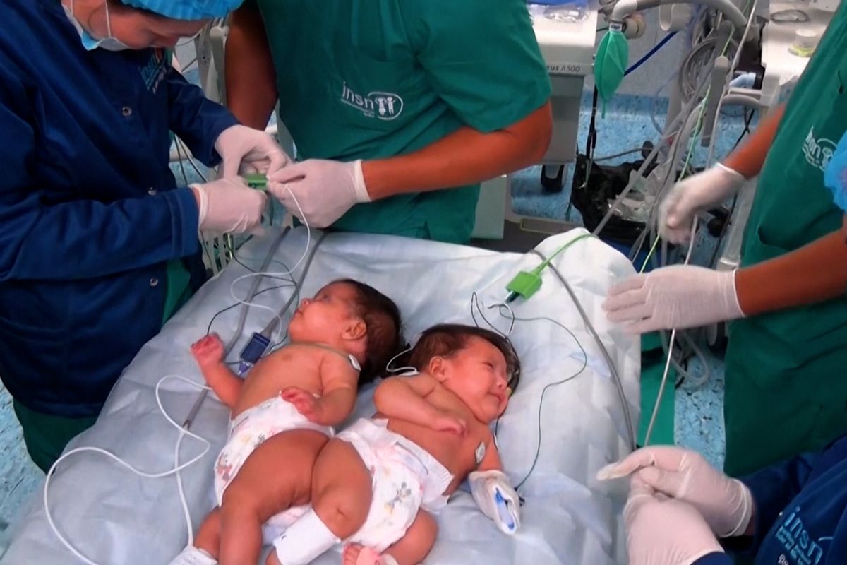 Vánoční zázrak: V Peru úspěšně oddělili dvouměsíční siamská dvojčata 
