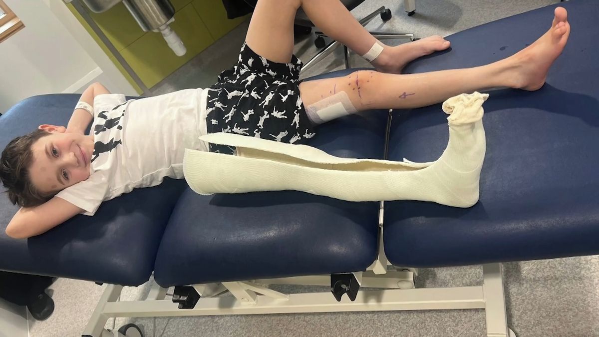 Prodloužení kostí. Průlomová metoda v dětské ortopedii umožňuje rychlý návrat k běžnému životu