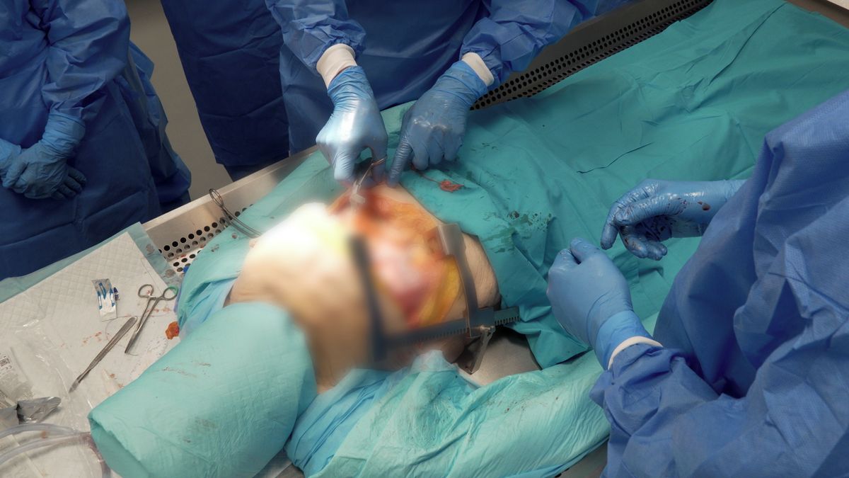 Probodnuté srdce? I takový pacient může přežít. Lékaři trénují specializovaný zákrok na tělech dárců