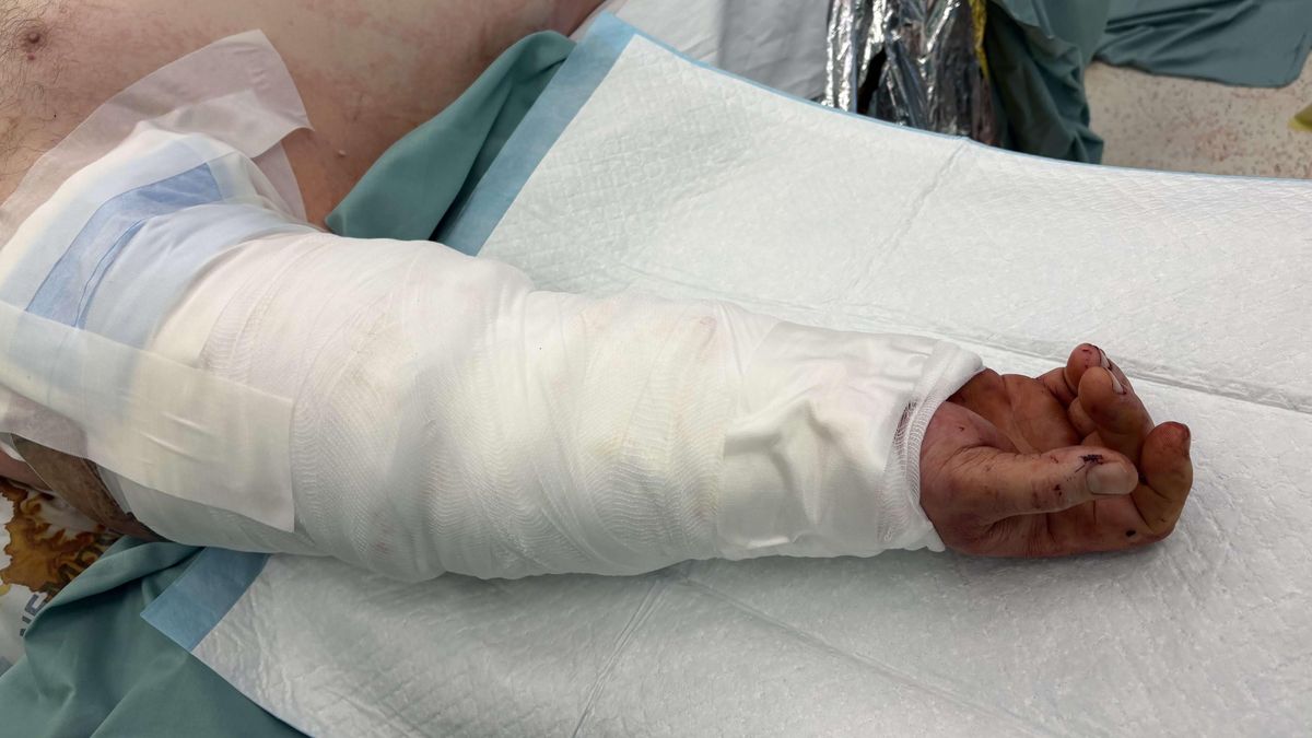 Pásový dopravník utrhl muži ruku. Lékaři v Brně mu jí přišili zpátky