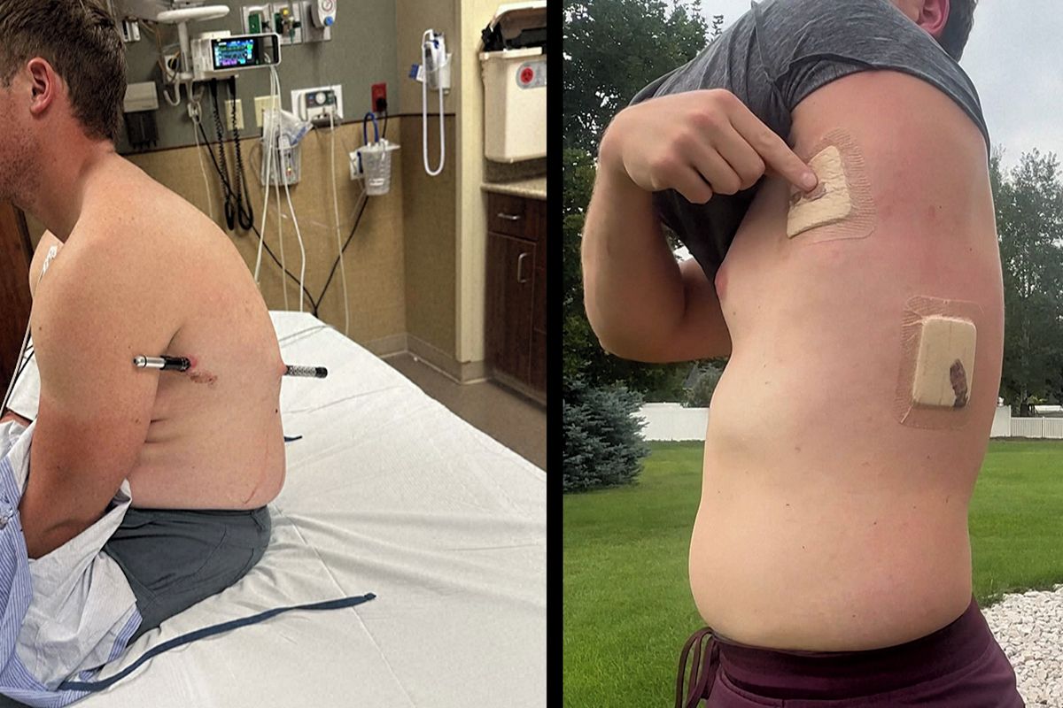 Američan se na túře propíchl trekingovou holí. S tyčí v těle ušel za záchranou 16 kilometrů